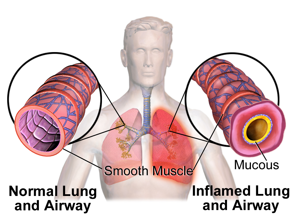 Blausen_0620_Lungs_NormalvsInflamedAirway